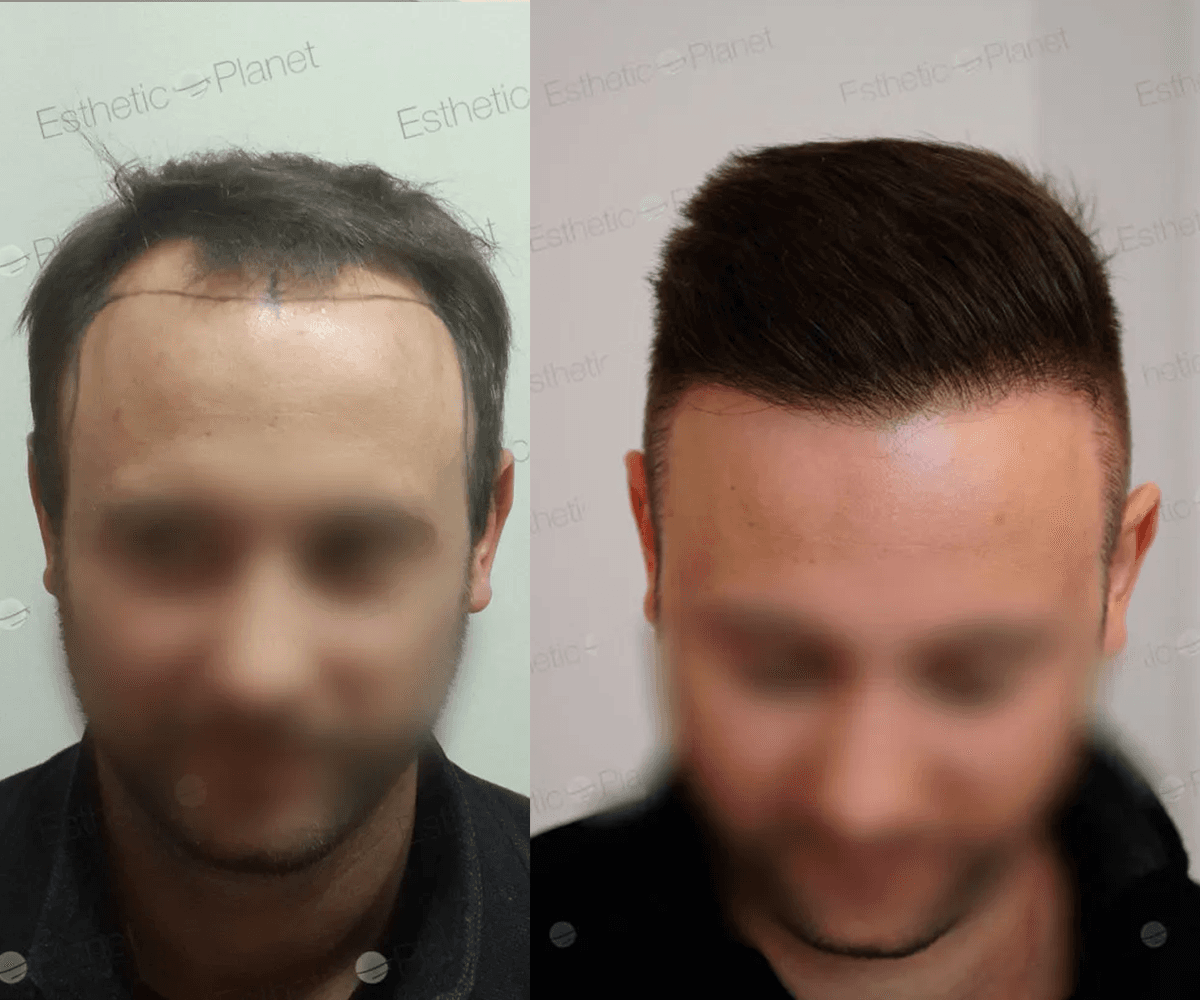 Avant Après 3800 FUE DR BEYHAN 2800 GREFFES