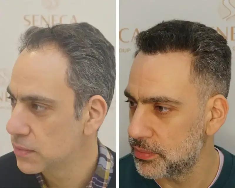 FUE