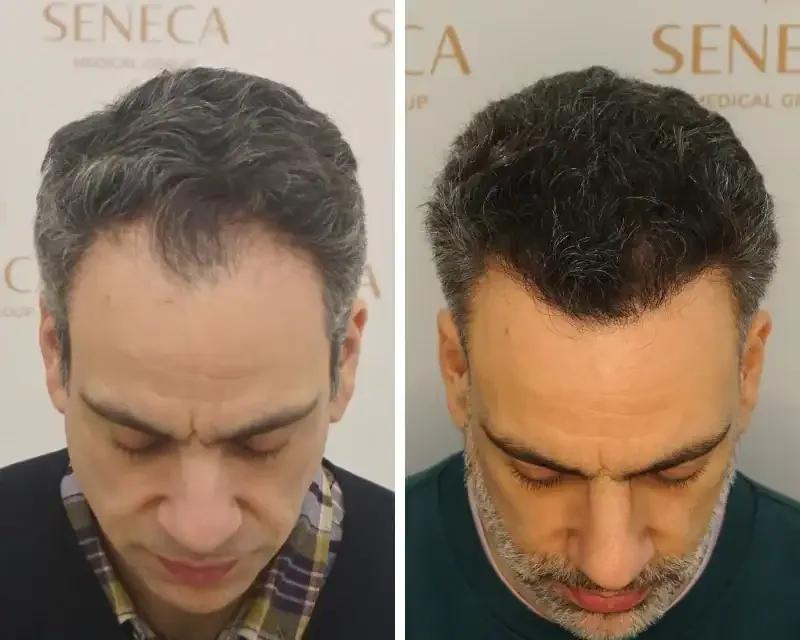 FUE