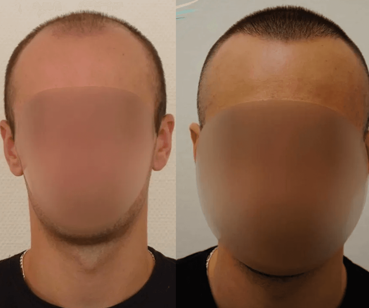 3000 FUE FRONT VIEW_