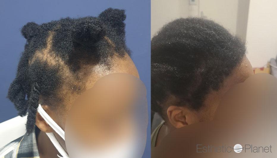 FUT AFRO HAIR FRONTAL HAIRLINE