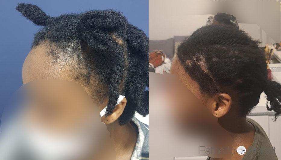 FUT AFRO HAIR FRONTAL HAIRLINE