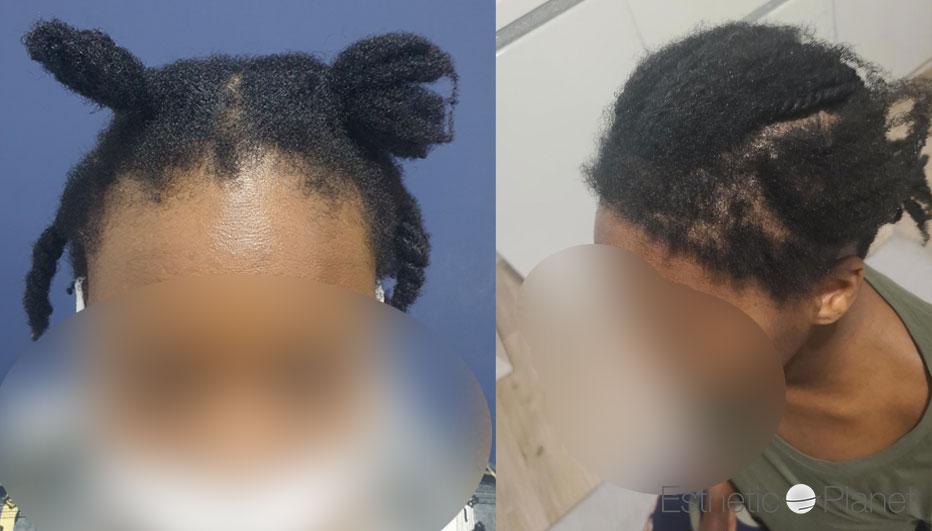 FUT AFRO HAIR FRONTAL HAIRLINE