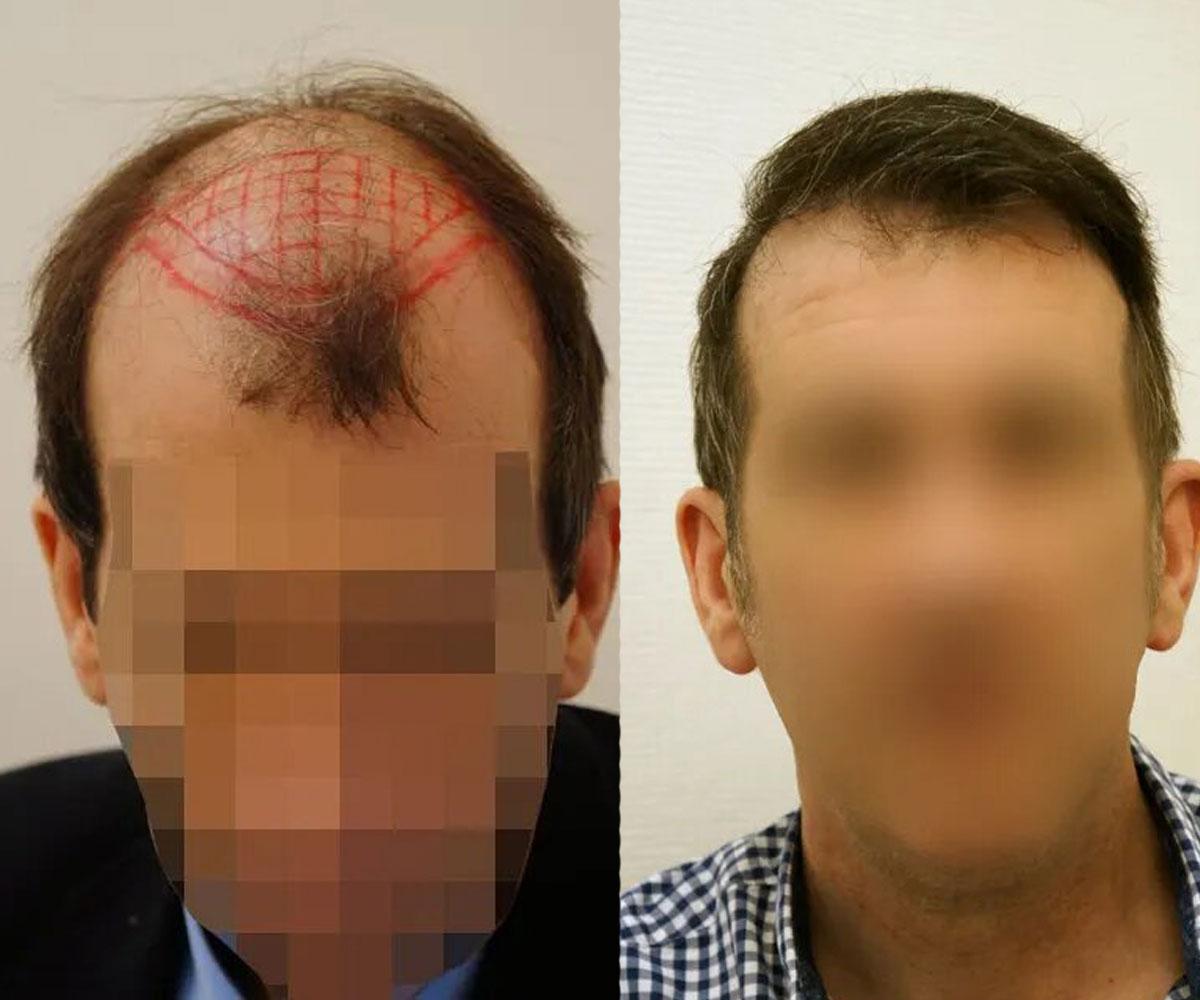 3800 FUT by Dr Beyhan