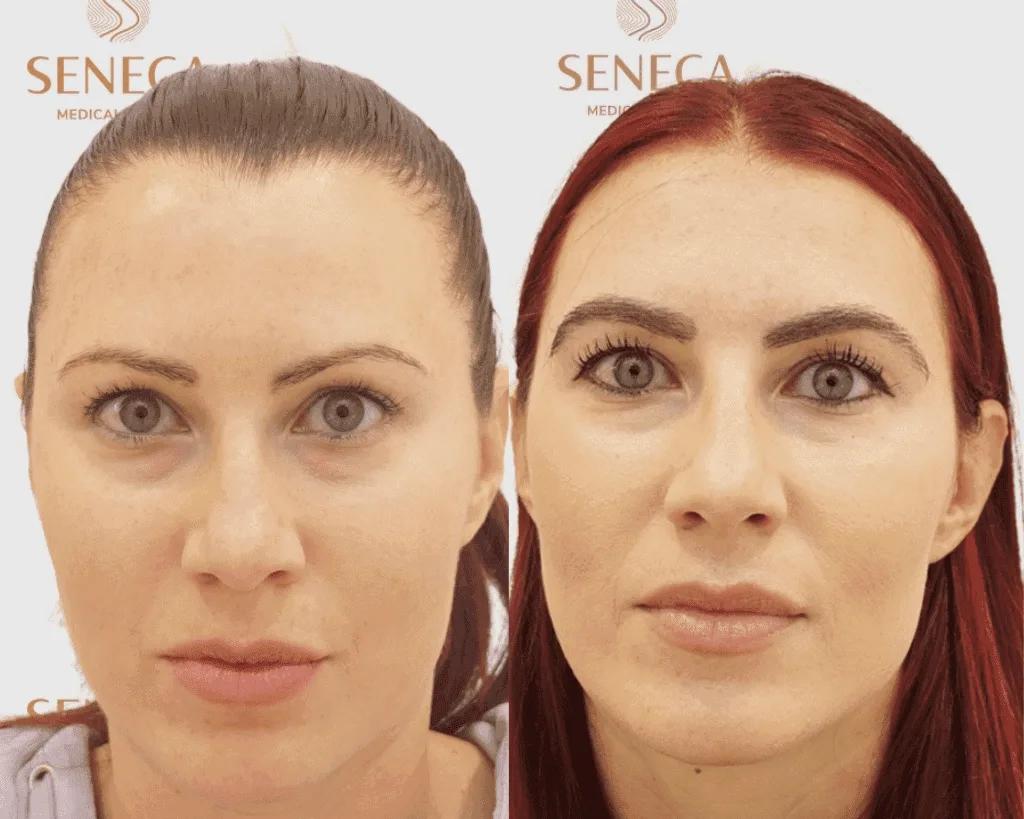 Eyebrow Transplant - Seneca Medical Group - Athens - Greece 1