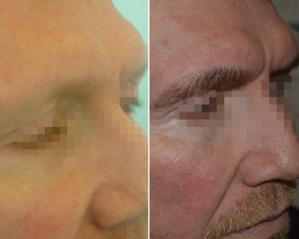 Eyebrow Transplant - Seneca Medical Group - Athens - Greece 2