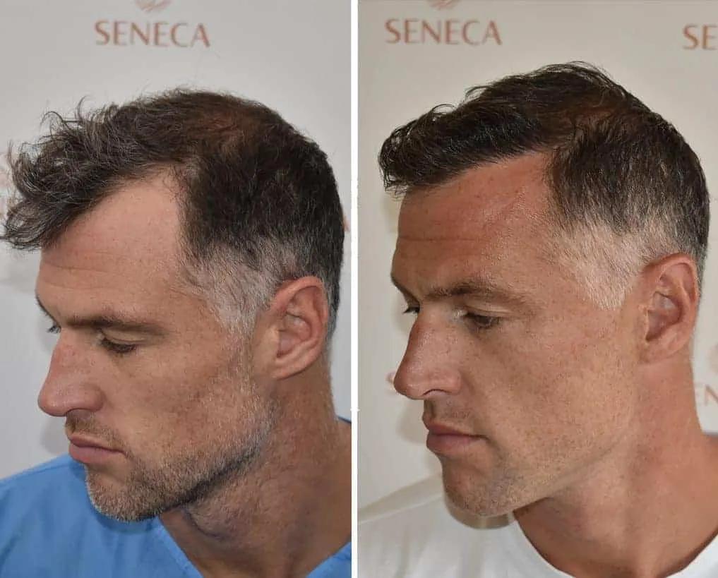 FUE by Doctor - Seneca Medical Group - Athens - Greece 1