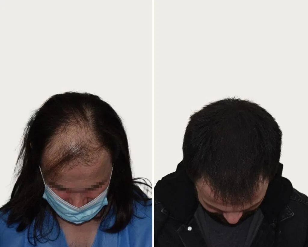 FUE by Doctor
