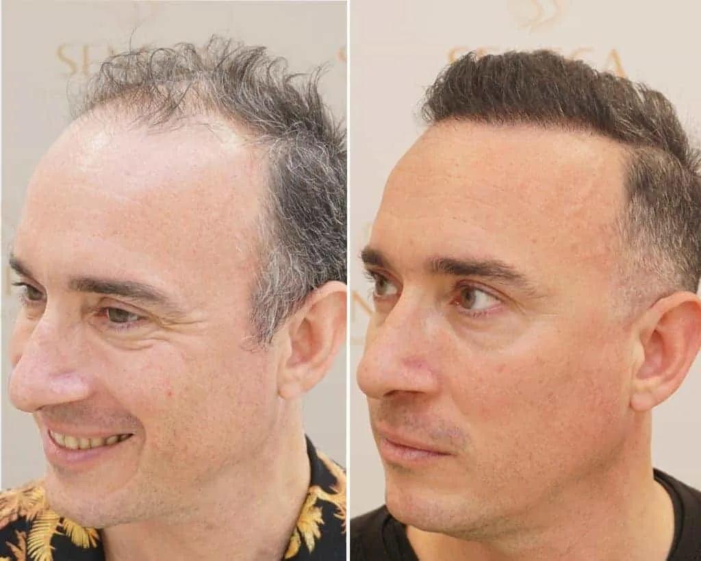 FUE by Doctor