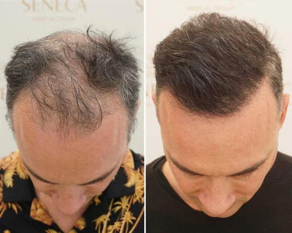 FUE by Doctor