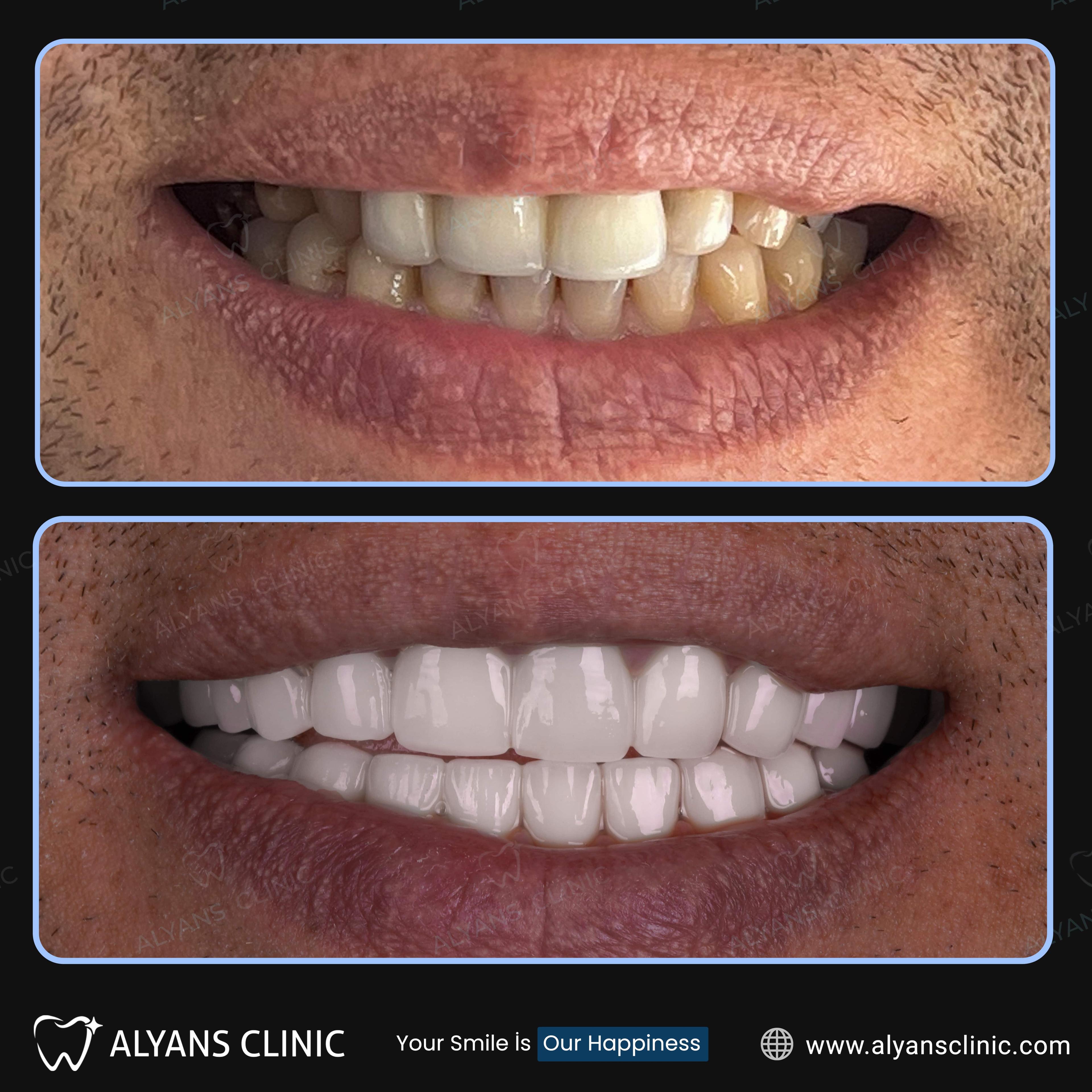 BEFORE + AFTER AZAT-min