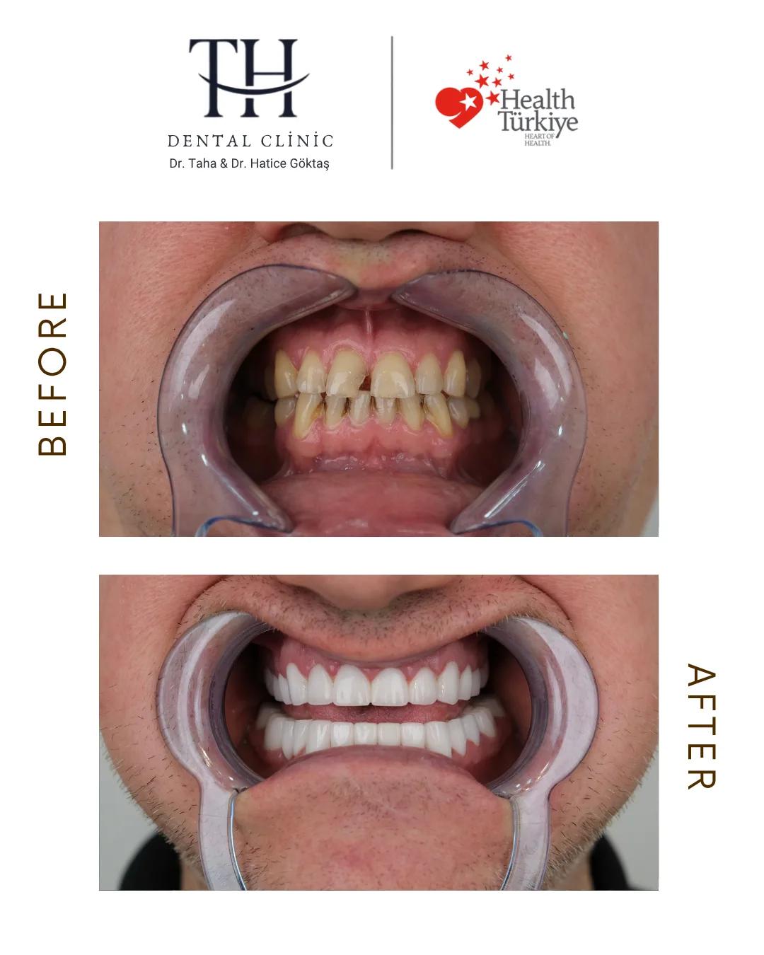 Emax crowns - TH Dental Clinic - Istanbul - Turkey 2