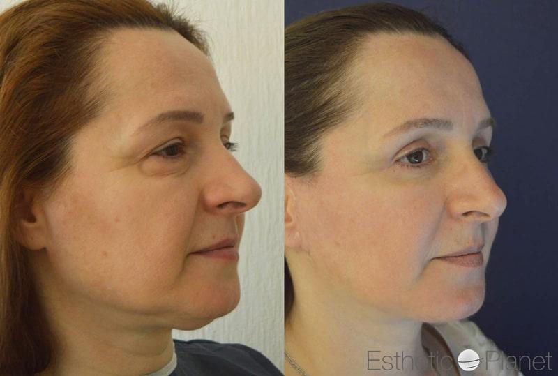 Blepharoplasty plastie - by Dr Ergin Er 