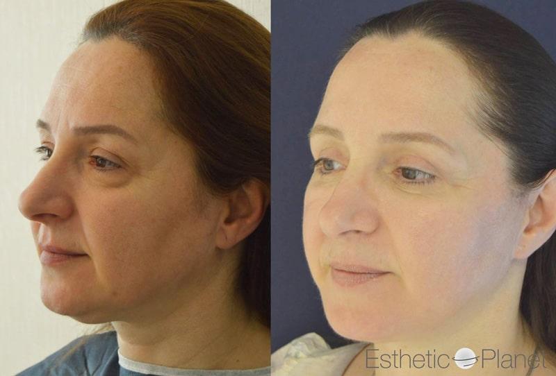 Blepharoplasty plastie - by Dr Ergin Er 