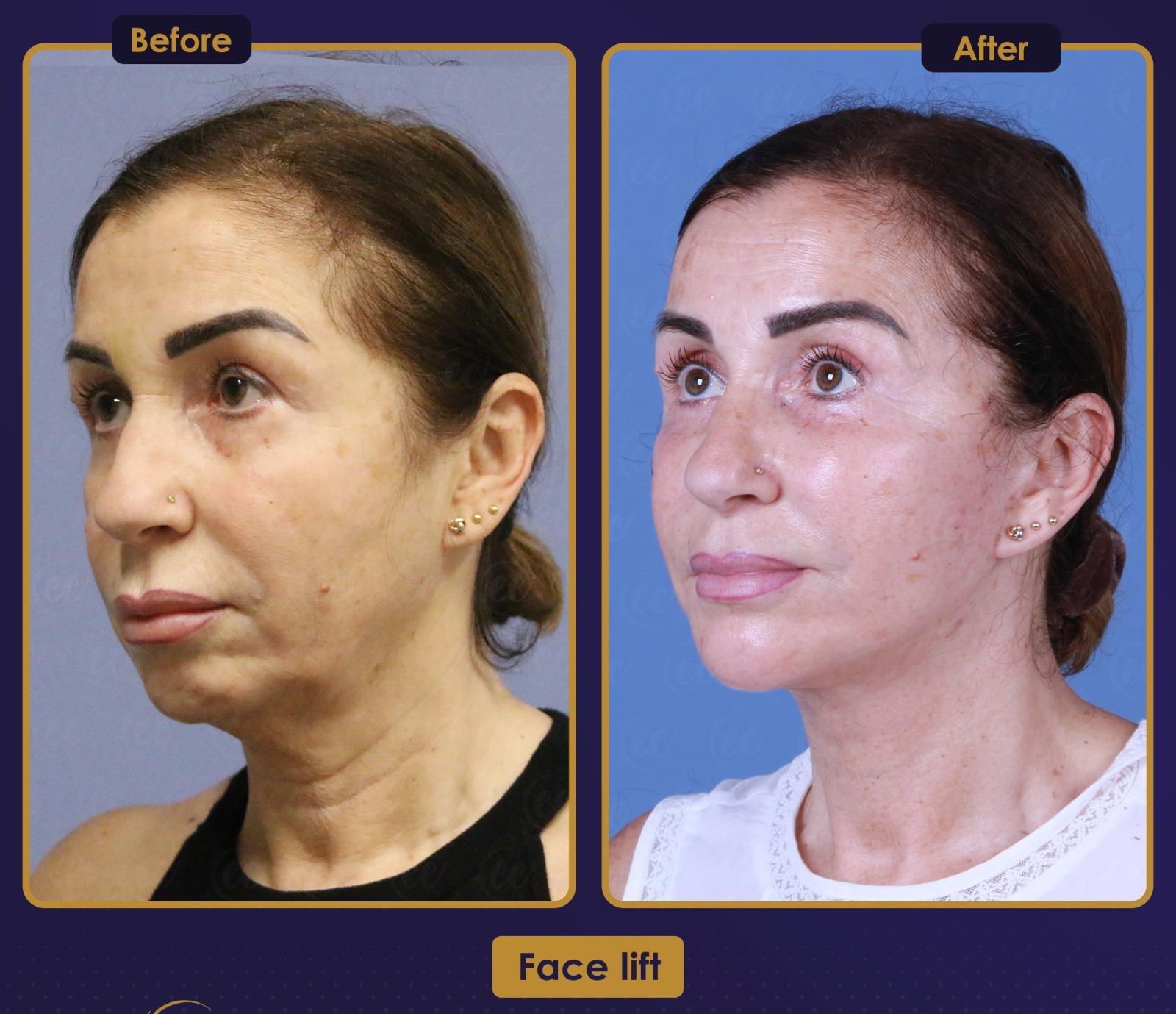 Résultat Estherian2