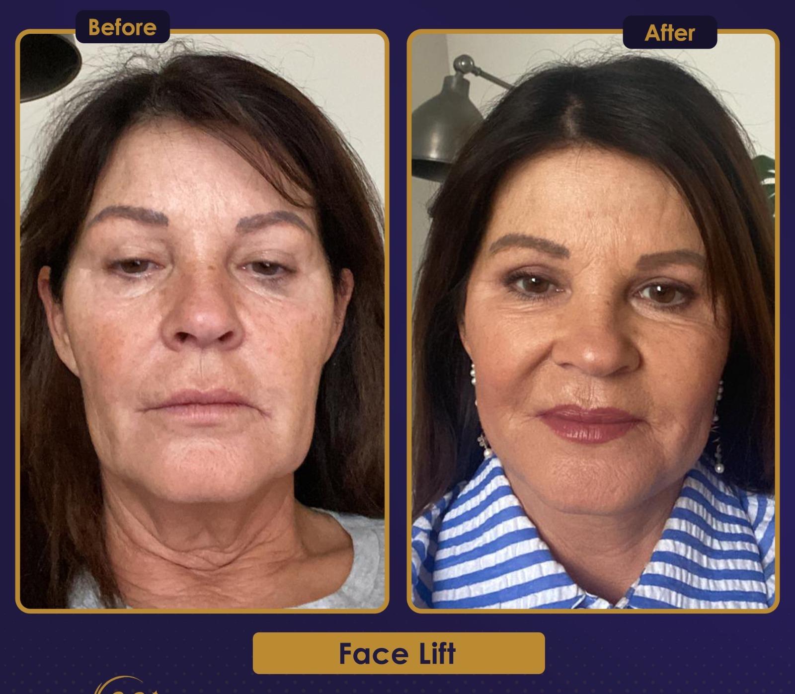 Résultat Estherian3