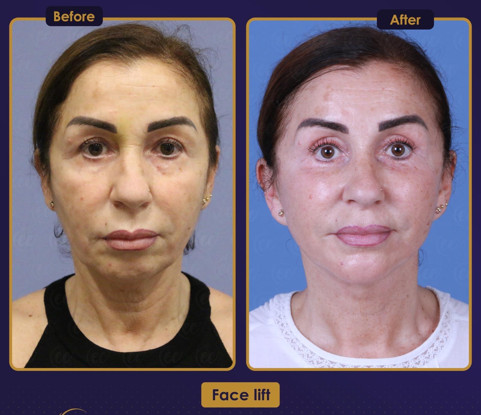 Résultat Estherian6