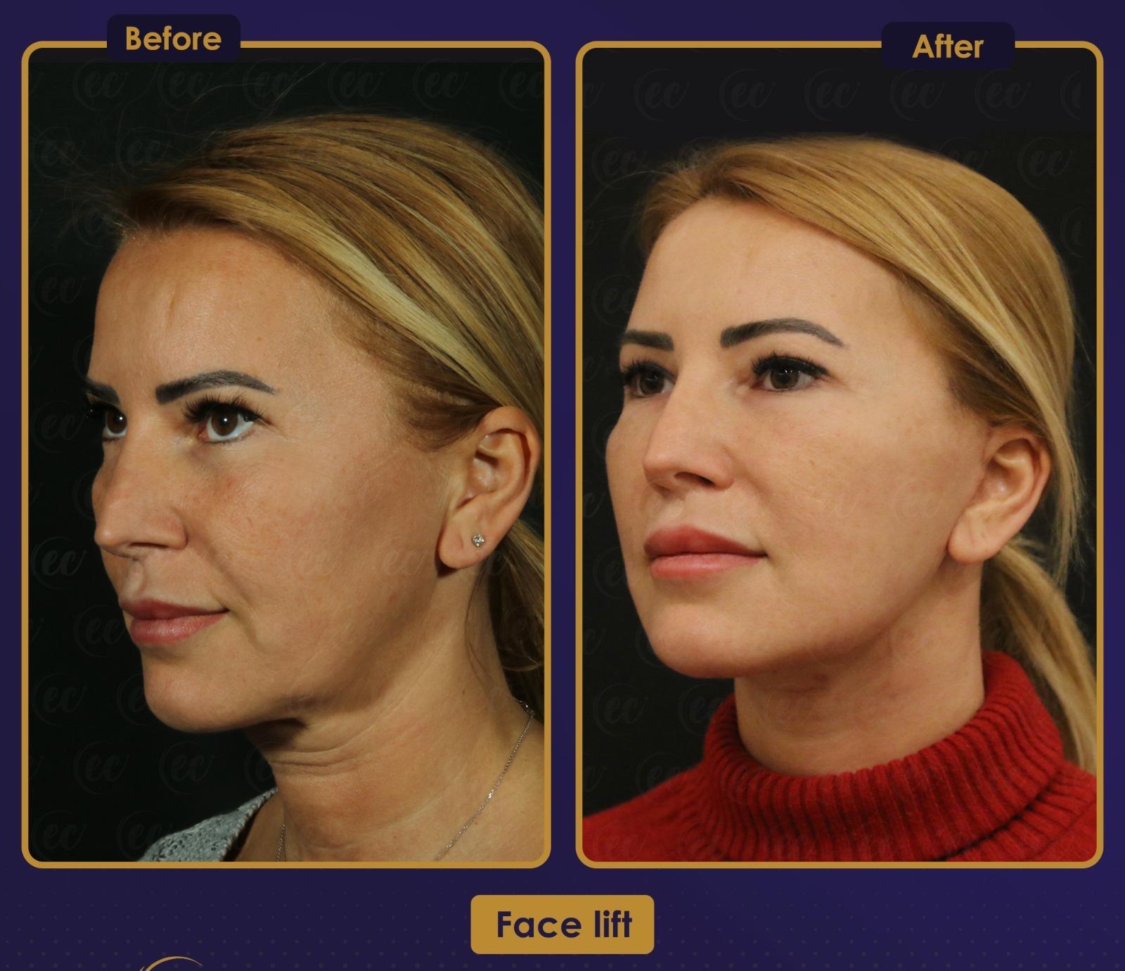 Résultat Estherian5