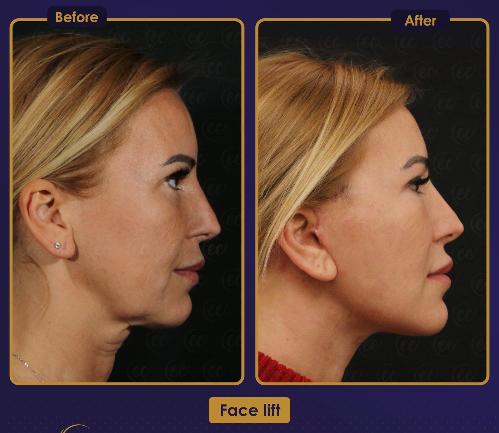 Résultat Estherian4