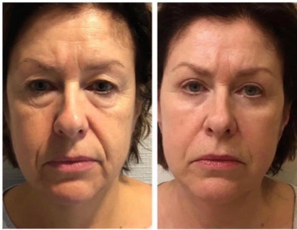 Face Lift by Dr Ergin Er 