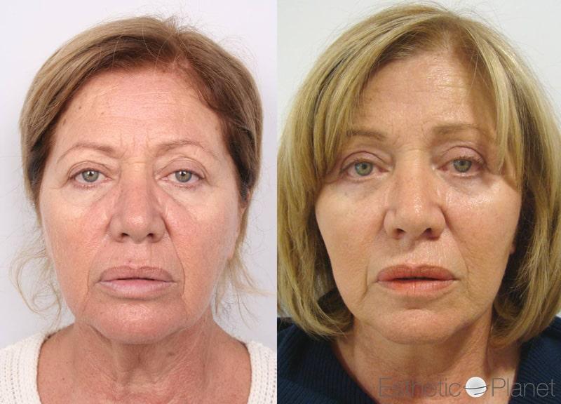 Blepharoplasty plastie - by Dr Ergin Er 