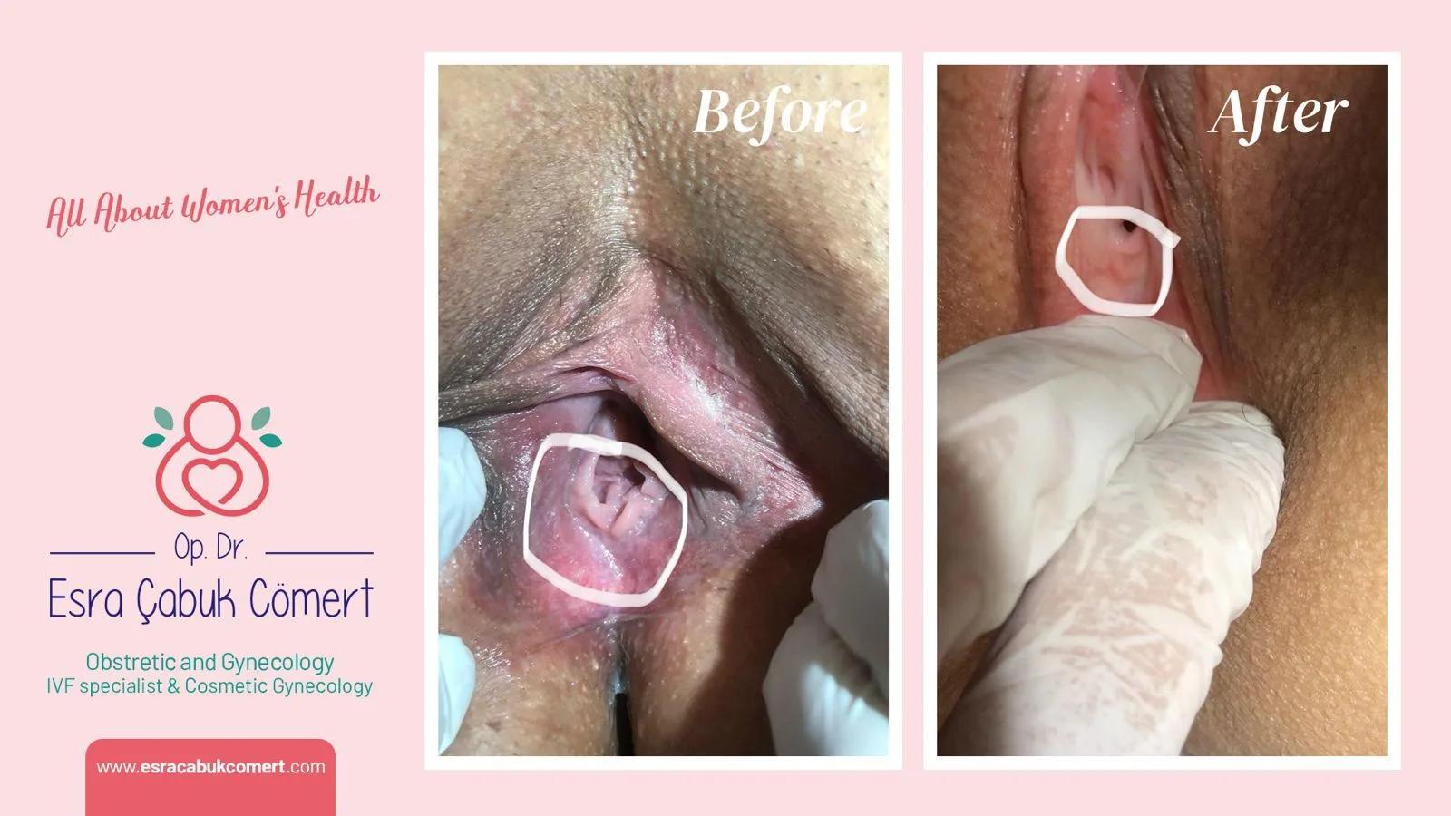 Hymenoplasty - OP.DR.ESRA ÇABUK COMERT - Istanbul - Turkey