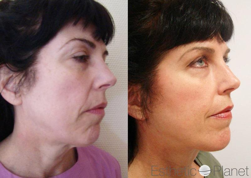 Blepharoplasty plastie - by Dr Ergin Er 