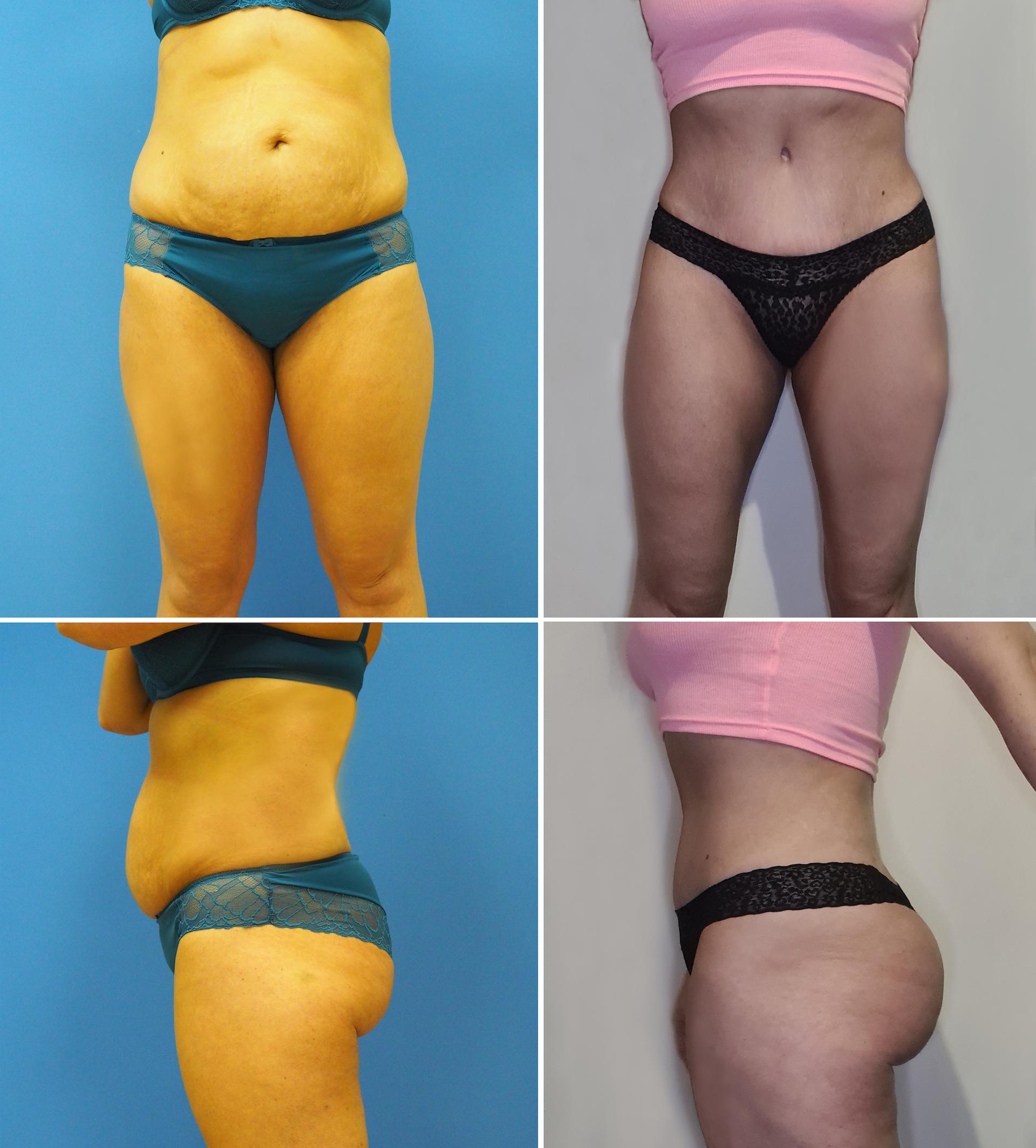 Tummy tuck, thigh lipo