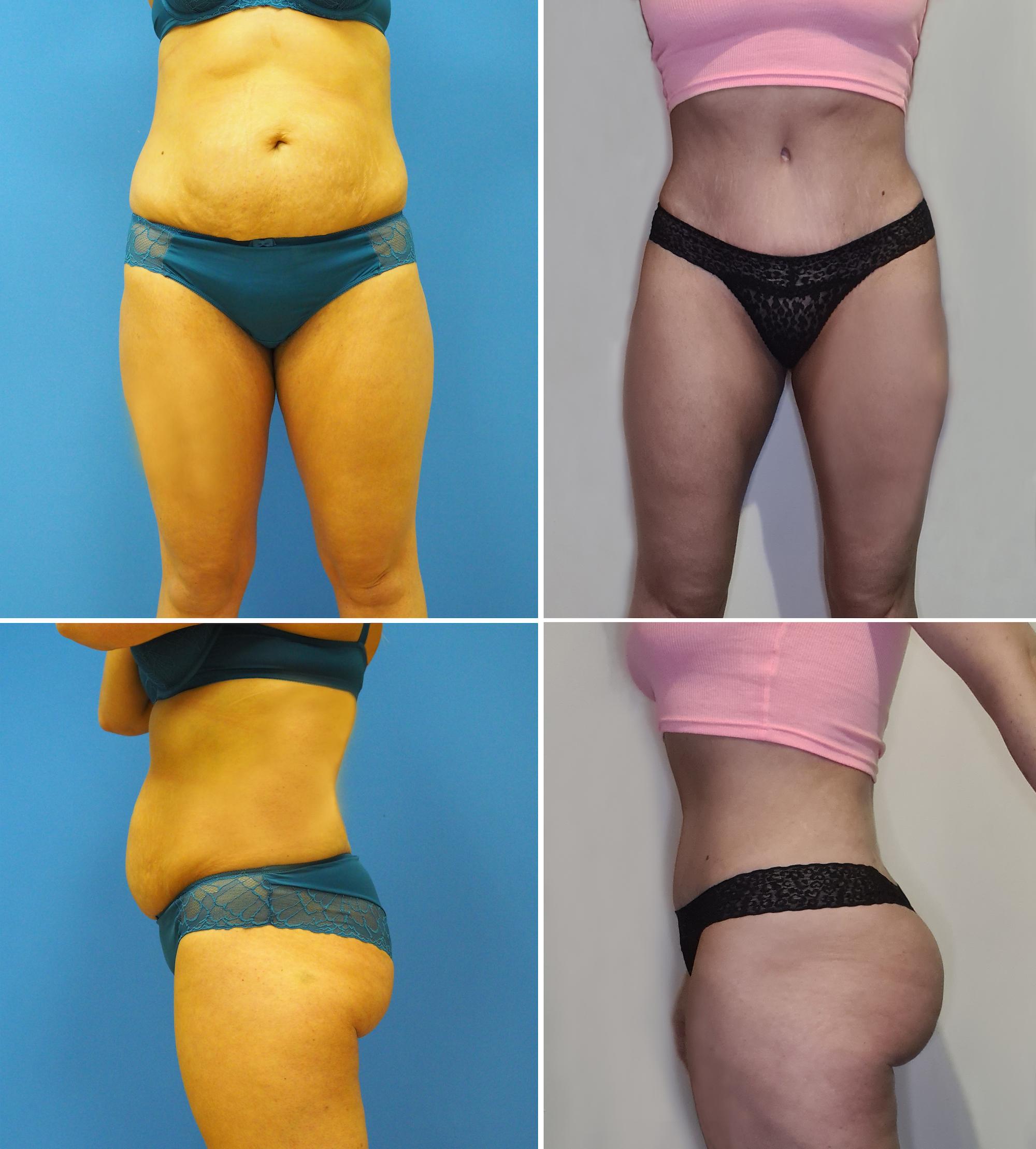 Tummy tuck, thigh lipo