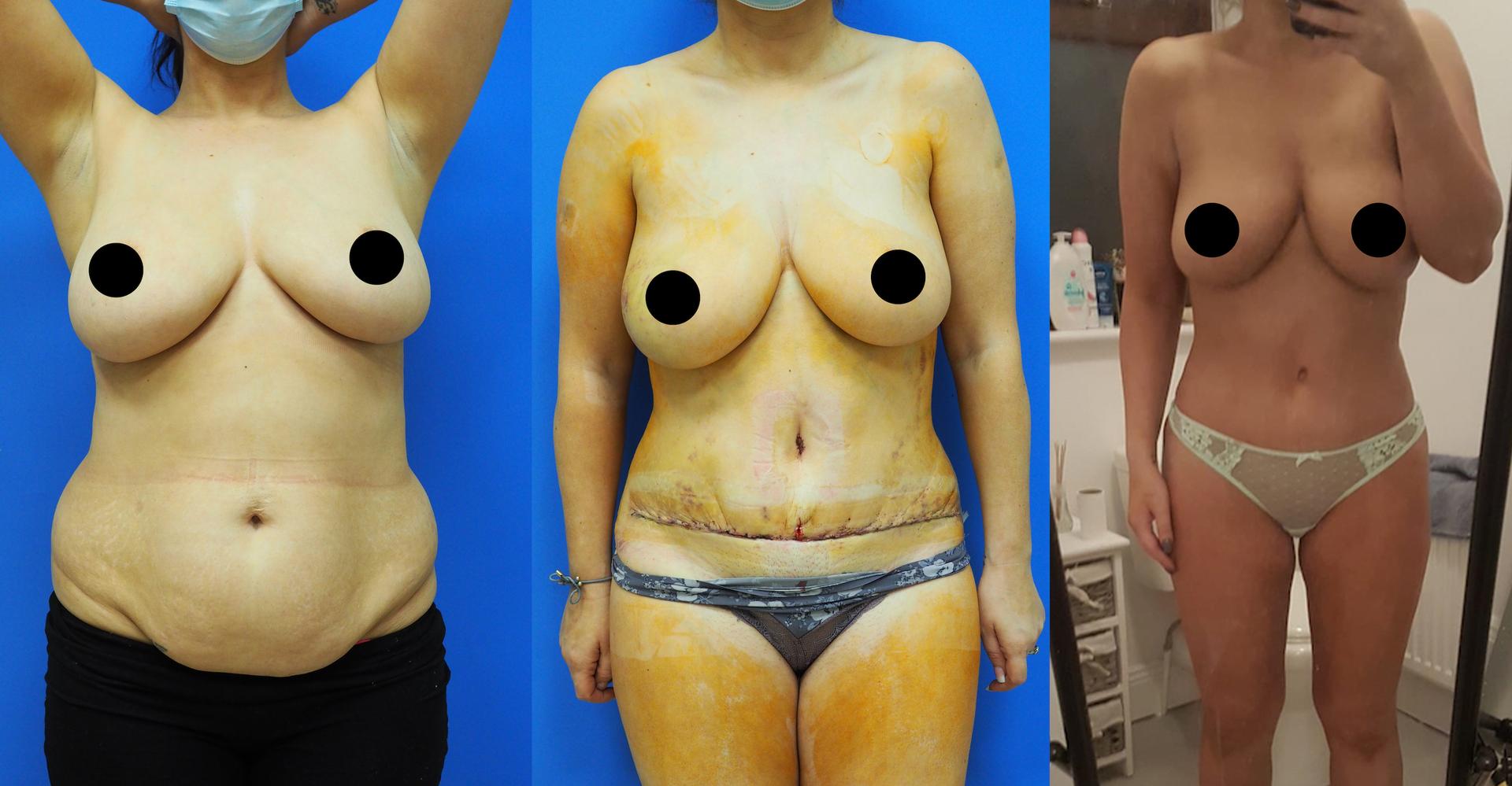 tummy tuck progress