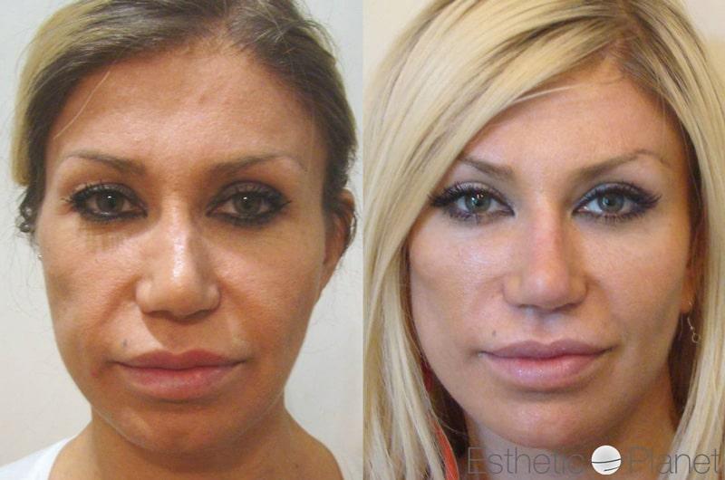Blepharoplasty plastie - by Dr Ergin Er 