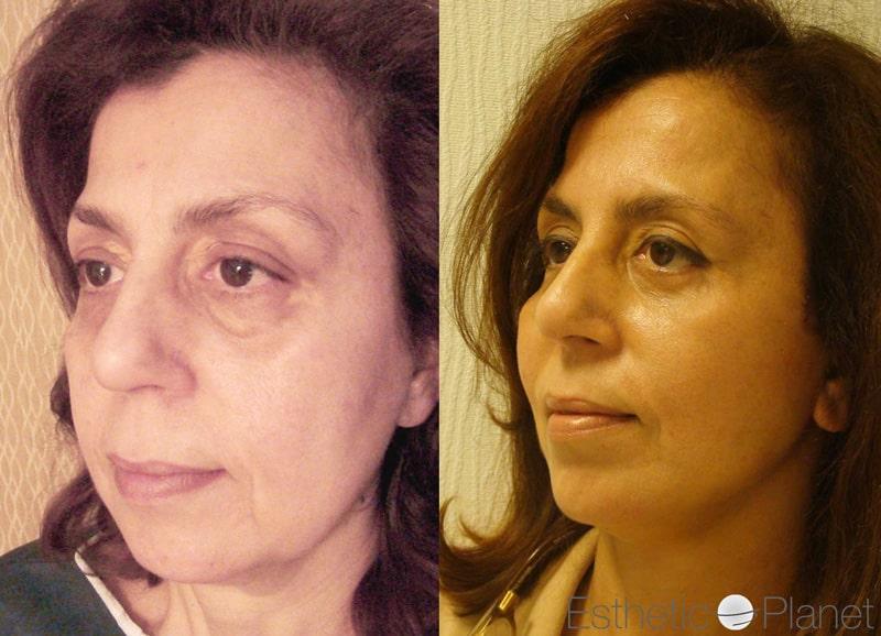 Blepharoplasty plastie - by Dr Ergin Er 