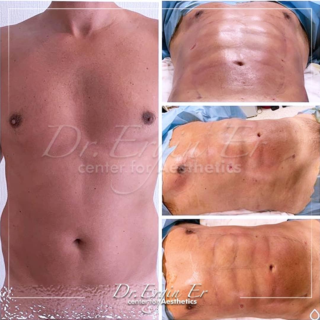 DR Ergin Er LIPO HD