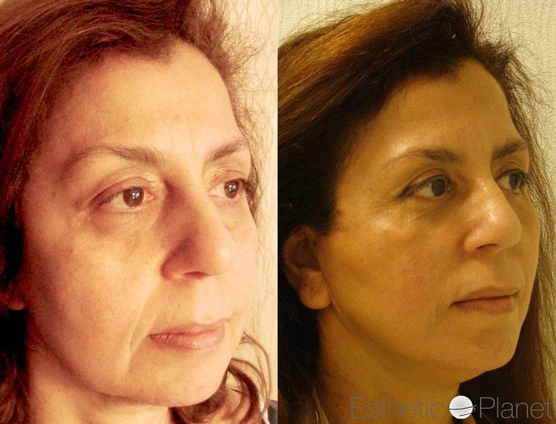 Blepharoplasty plastie - by Dr Ergin Er 