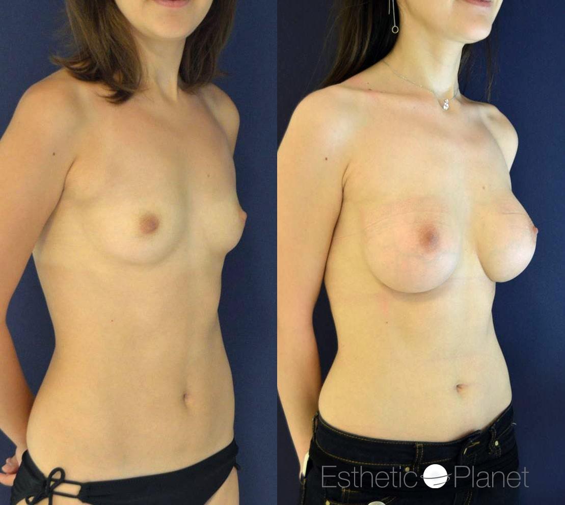 Breast augmentation by Dr Ergin Er 