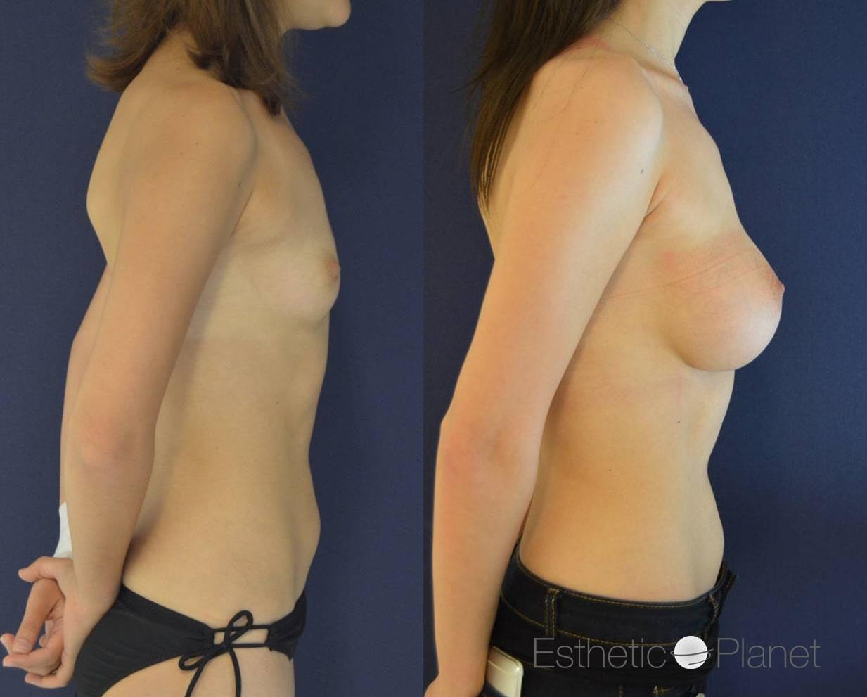 Breast augmentation by Dr Ergin Er 