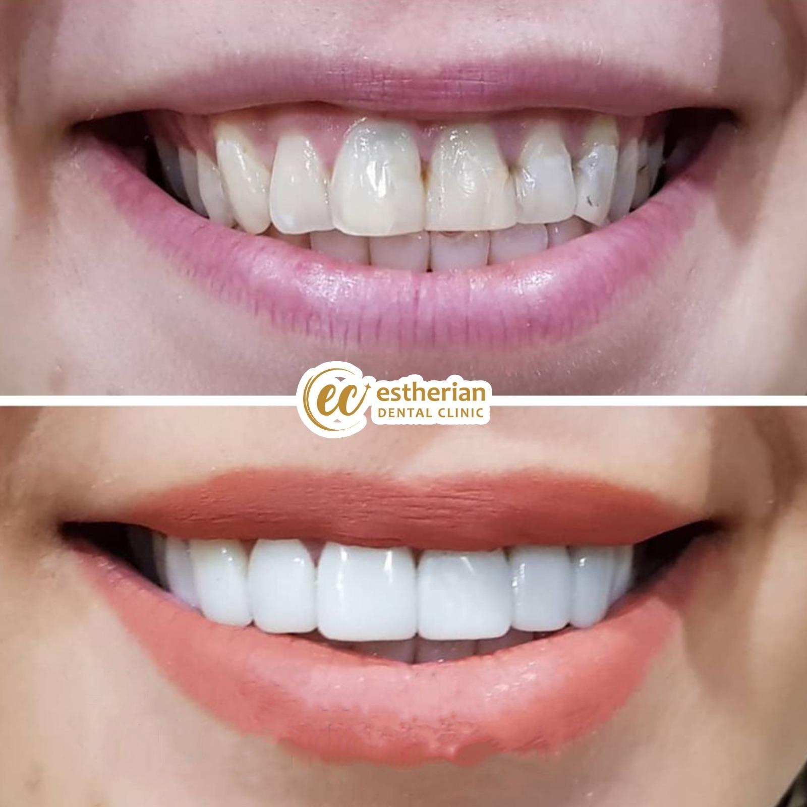 Estherian facette pelliculaires2