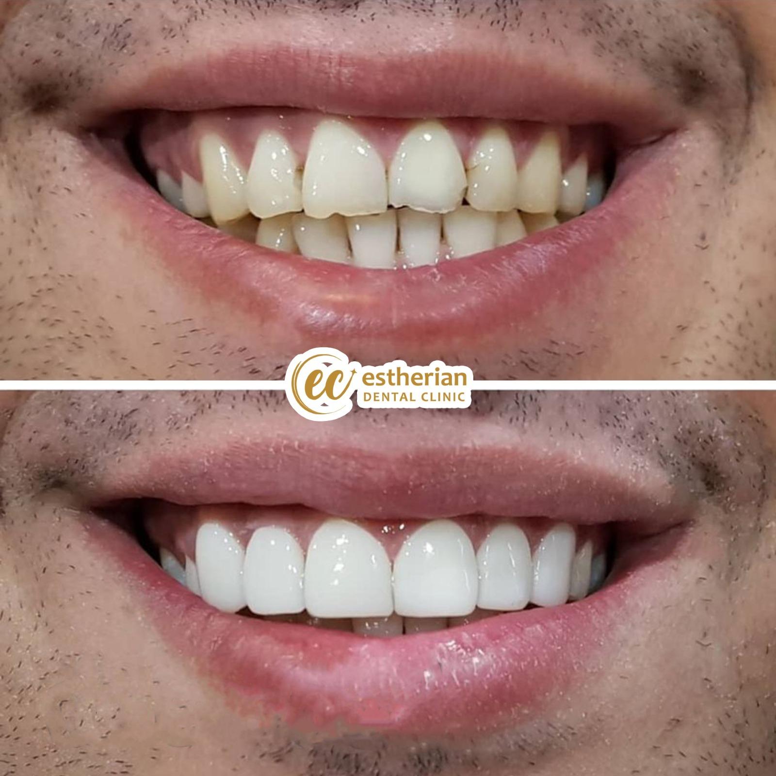 Estherian facette pelliculaires5