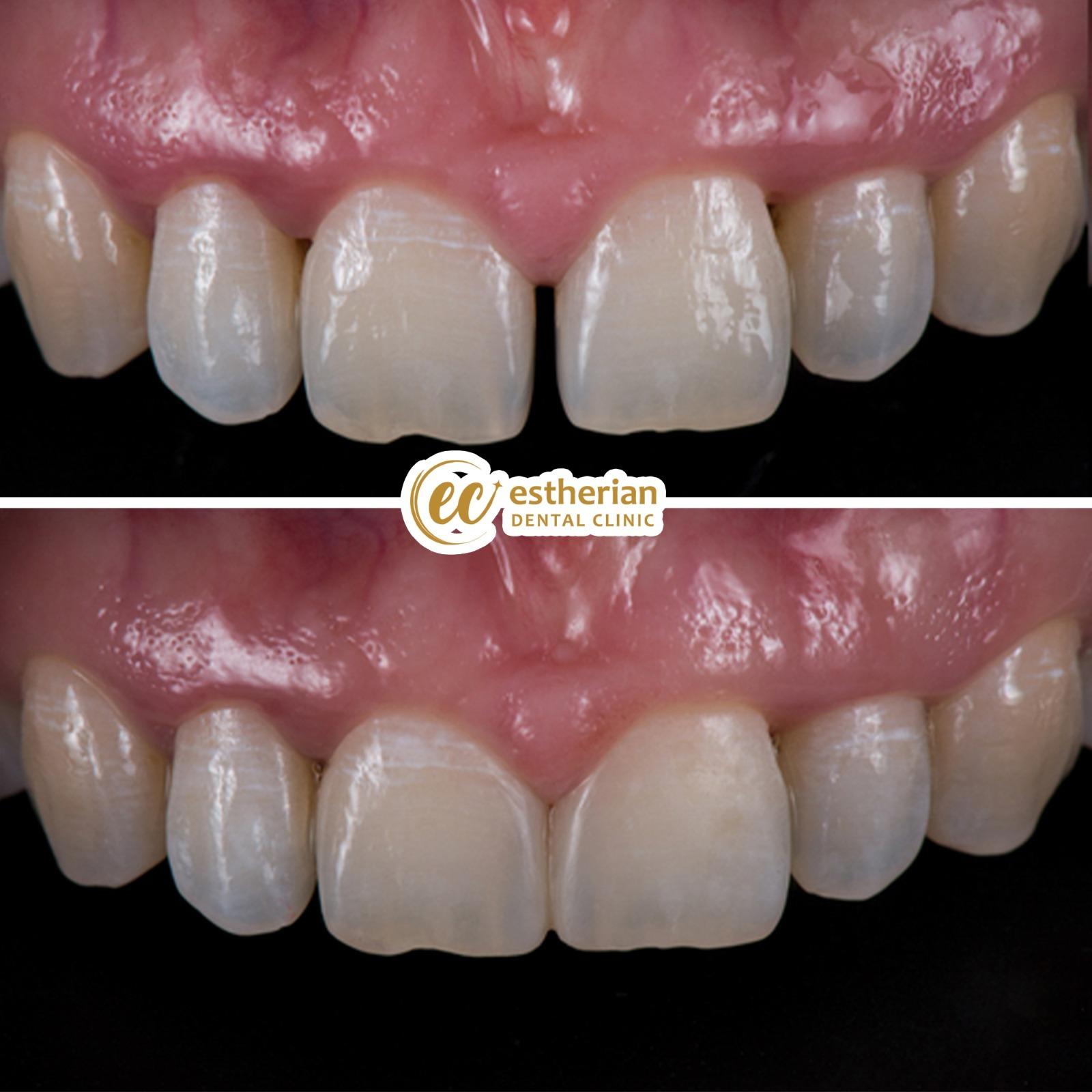 Estherian facette pelliculaires6