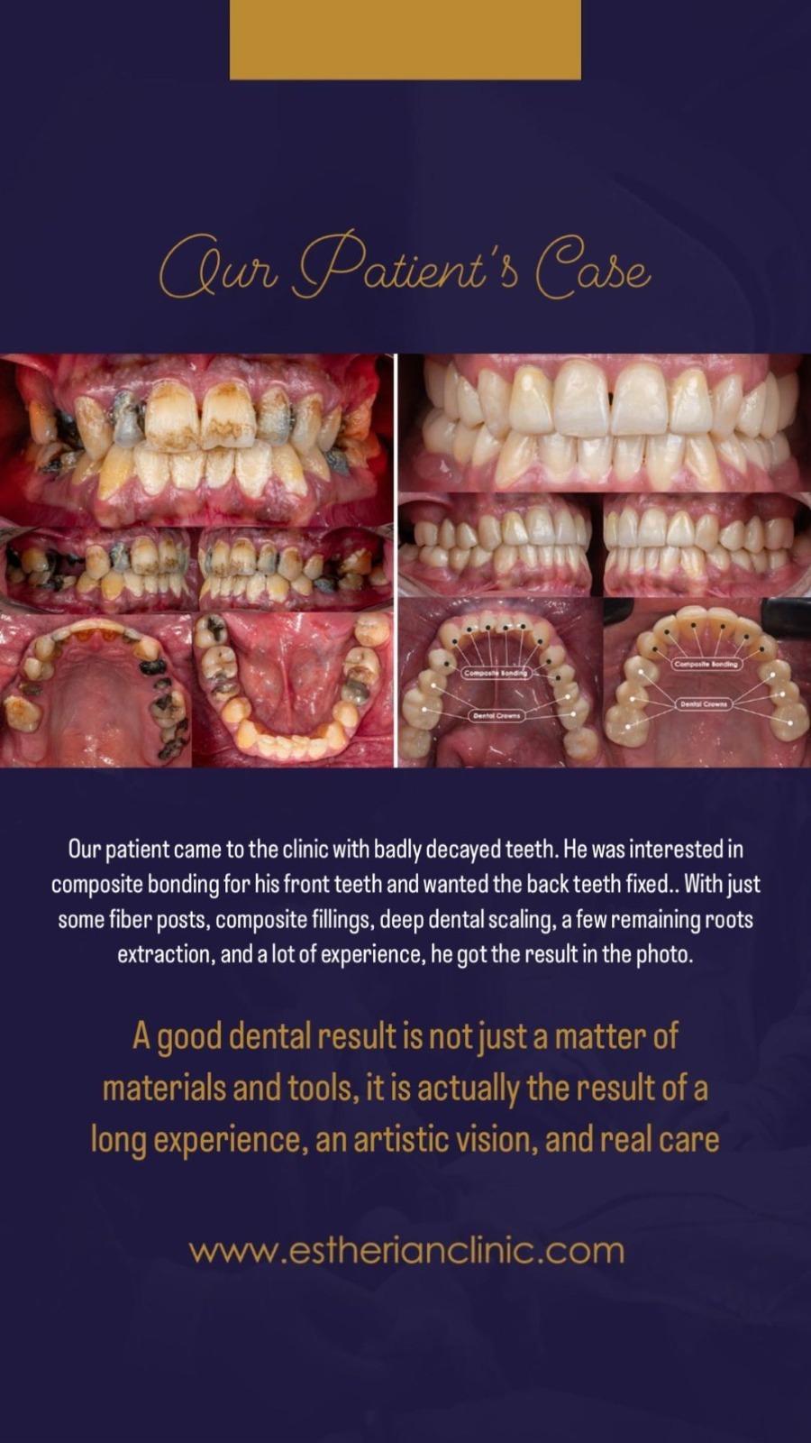 Estherian facette pelliculaires1