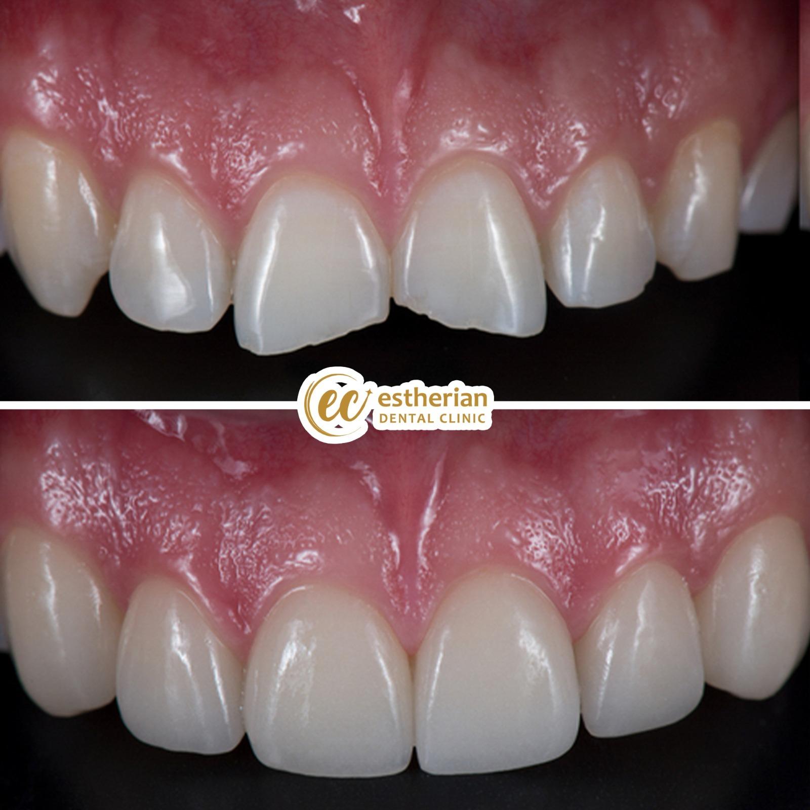 Estherian facette pelliculaires3