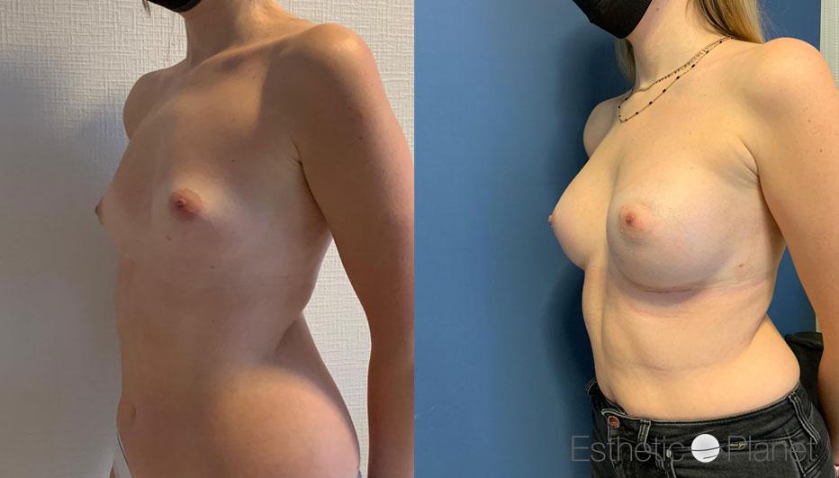 Breast augmentation by Dr Ergin Er 