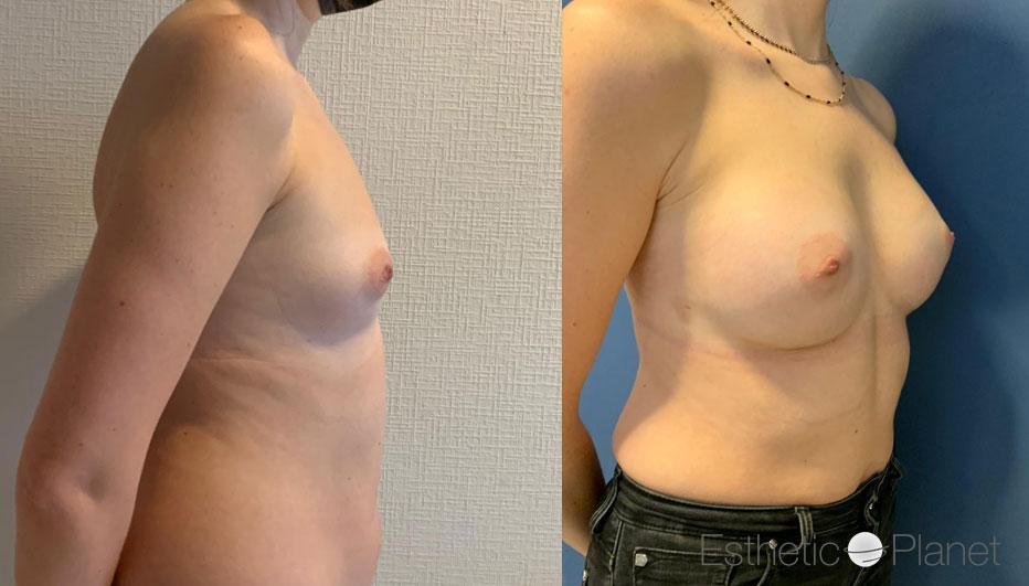 Breast augmentation by Dr Ergin Er 