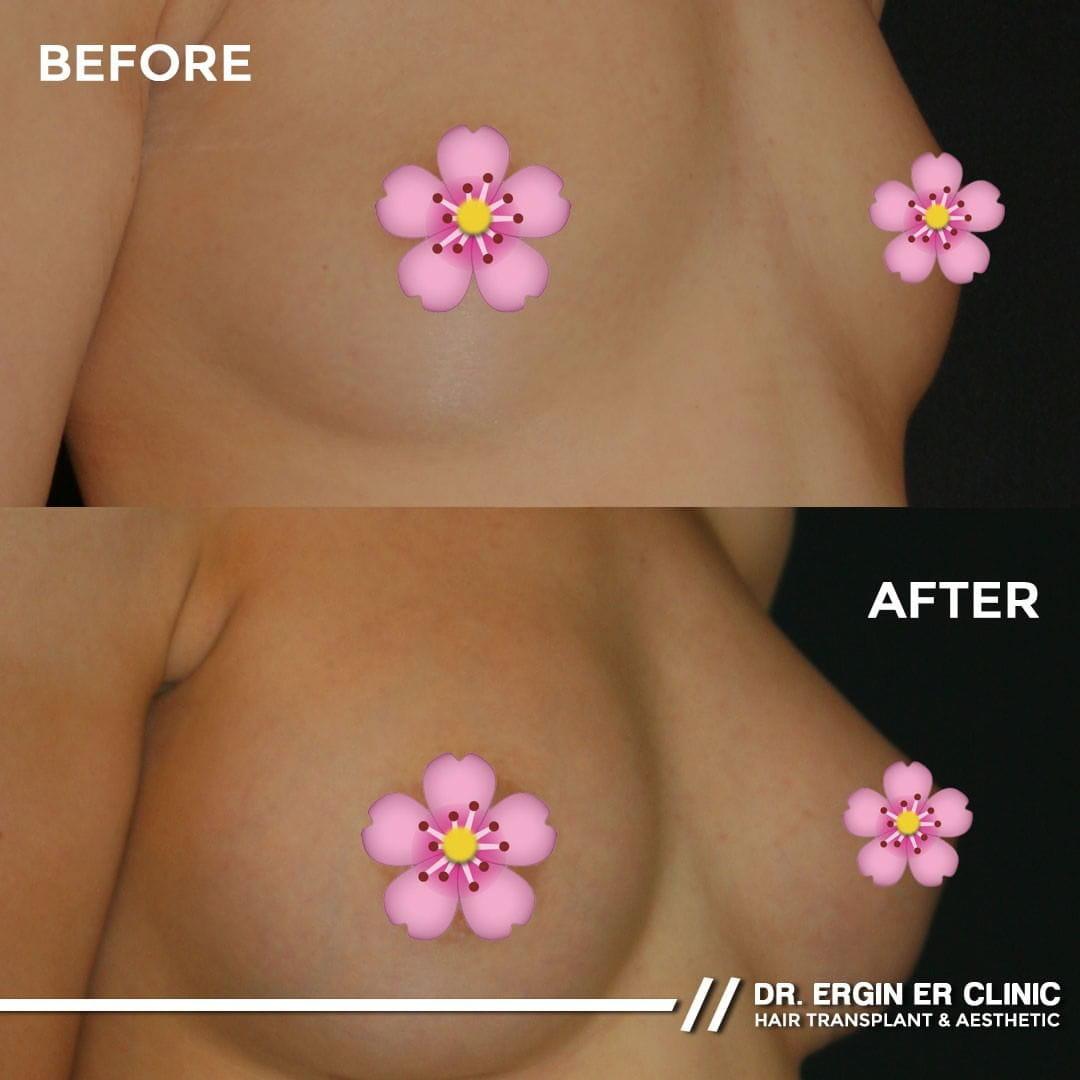 Breast augmentation by Dr Ergin Er 