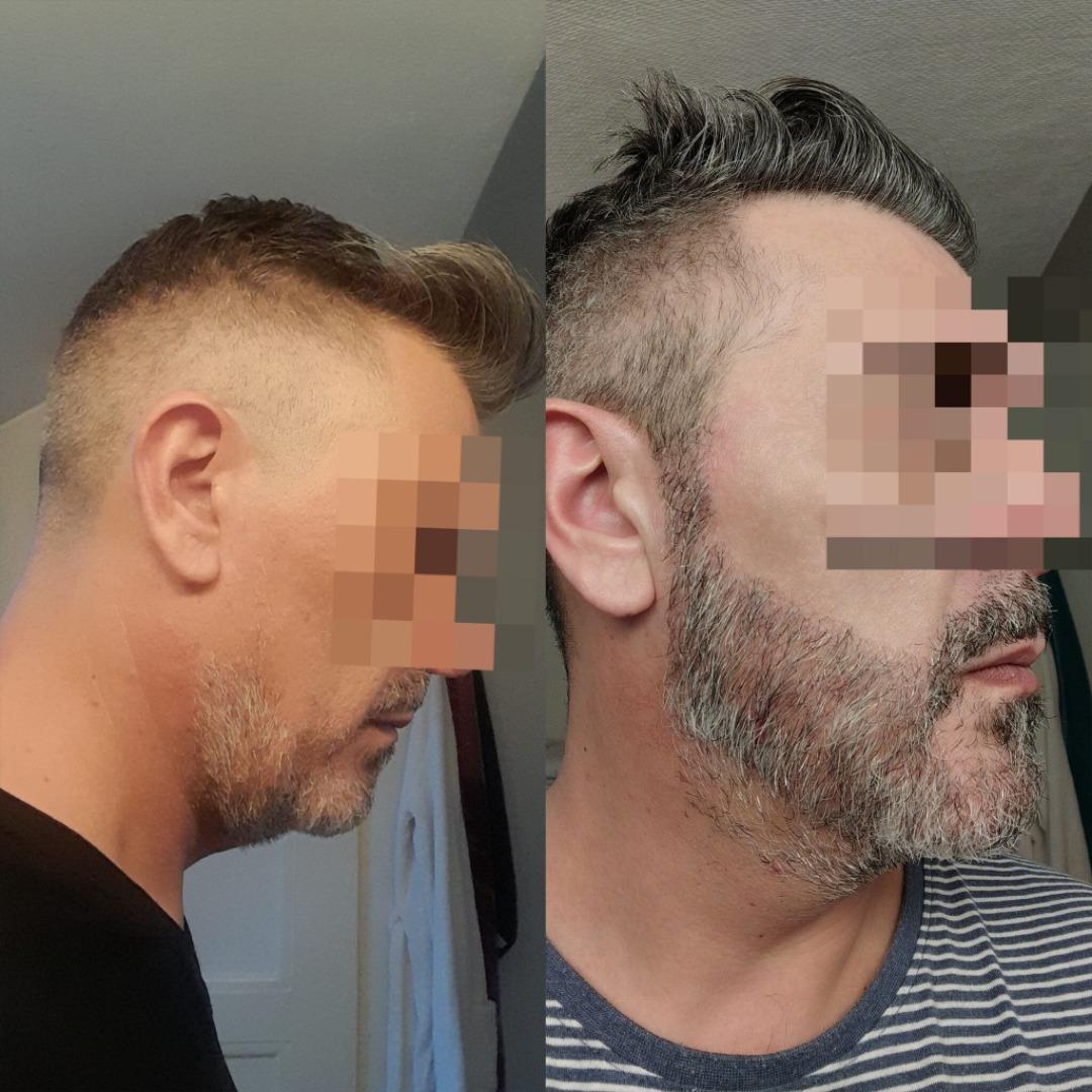 Beard Transplant by Esthetic Planet Team