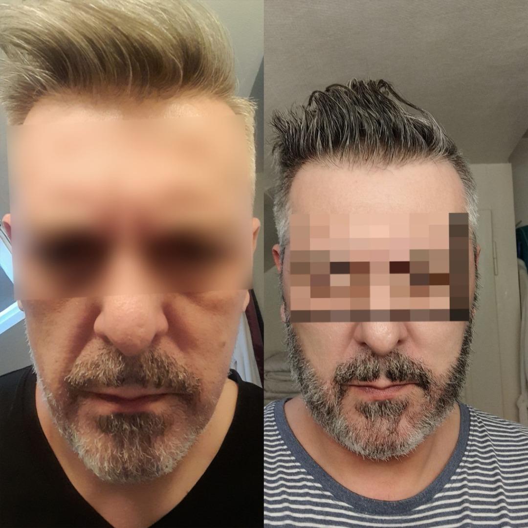 Beard Transplant by Esthetic Planet Team