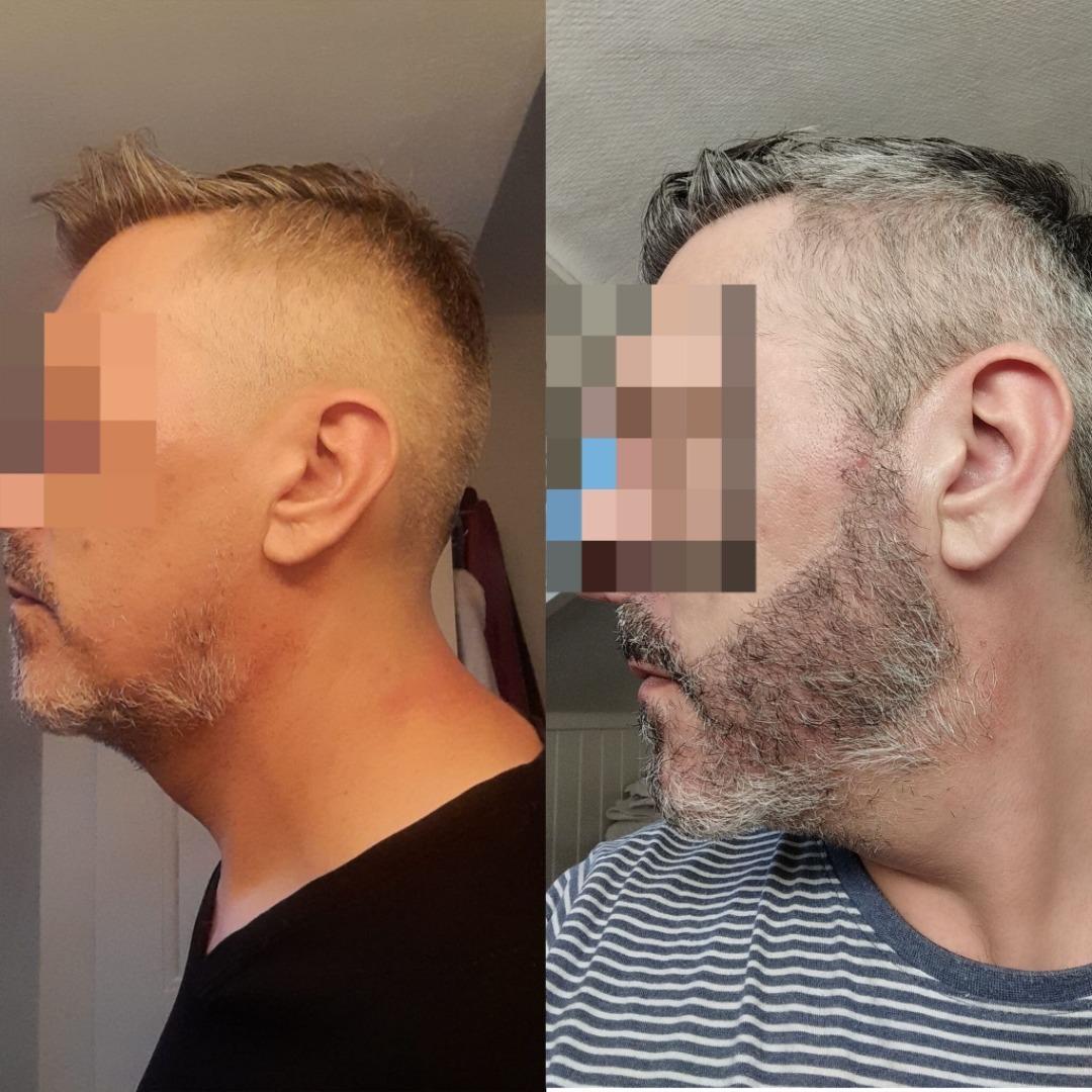 Beard Transplant by Esthetic Planet Team