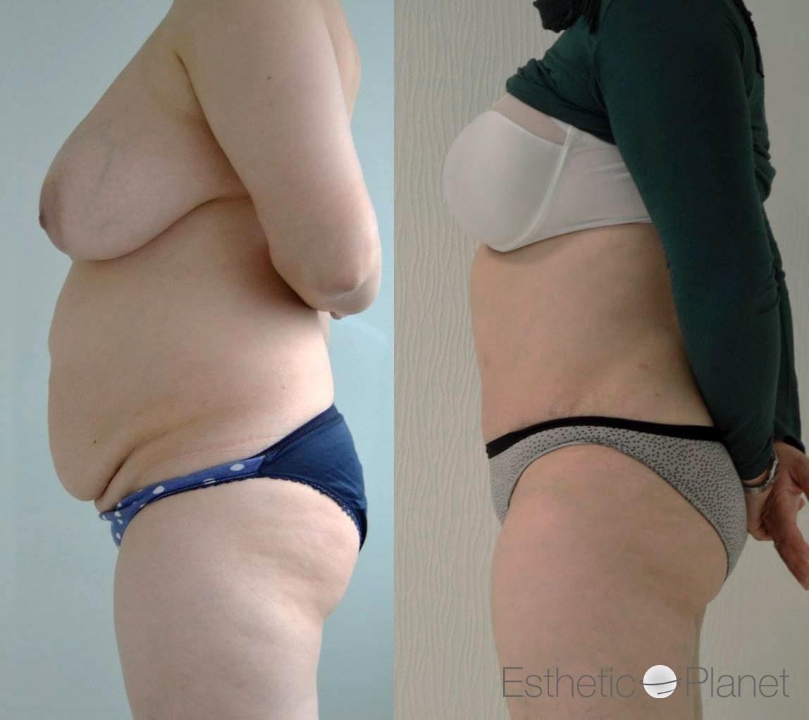 DR ERGIN ER ISTANBUL RESULTS SURGERY 40