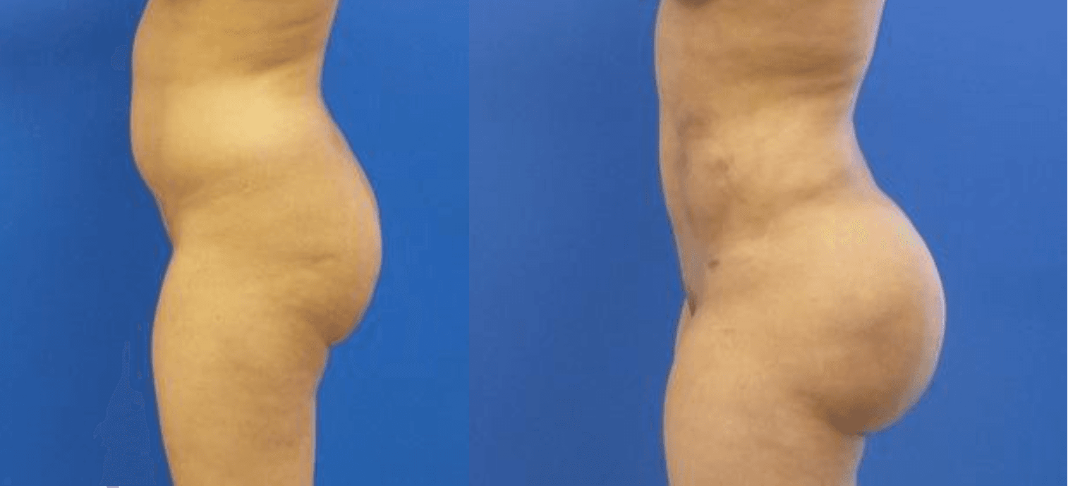 Results BBL by Dr Miklos Molnar