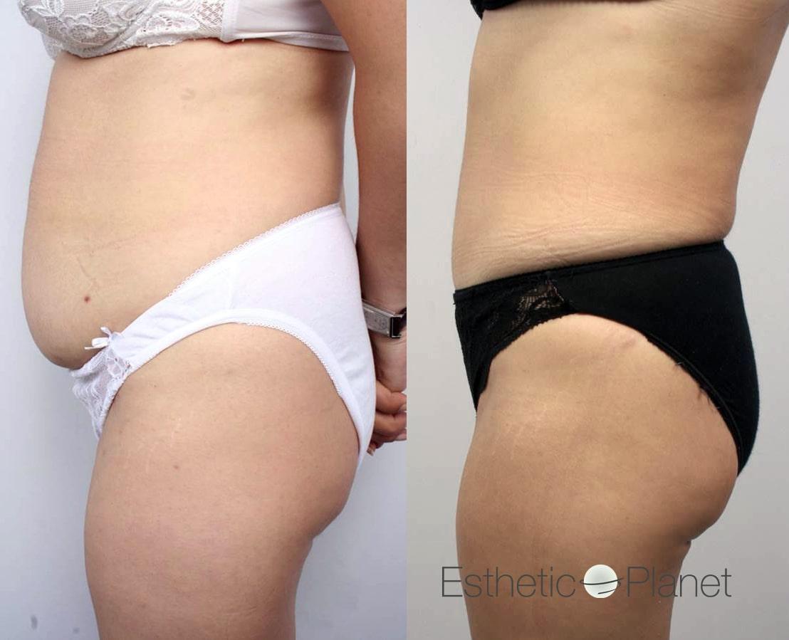 DR ERGIN ER ISTANBUL RESULTS SURGERY